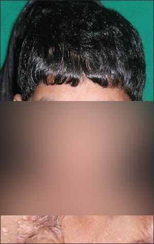 childneckburn